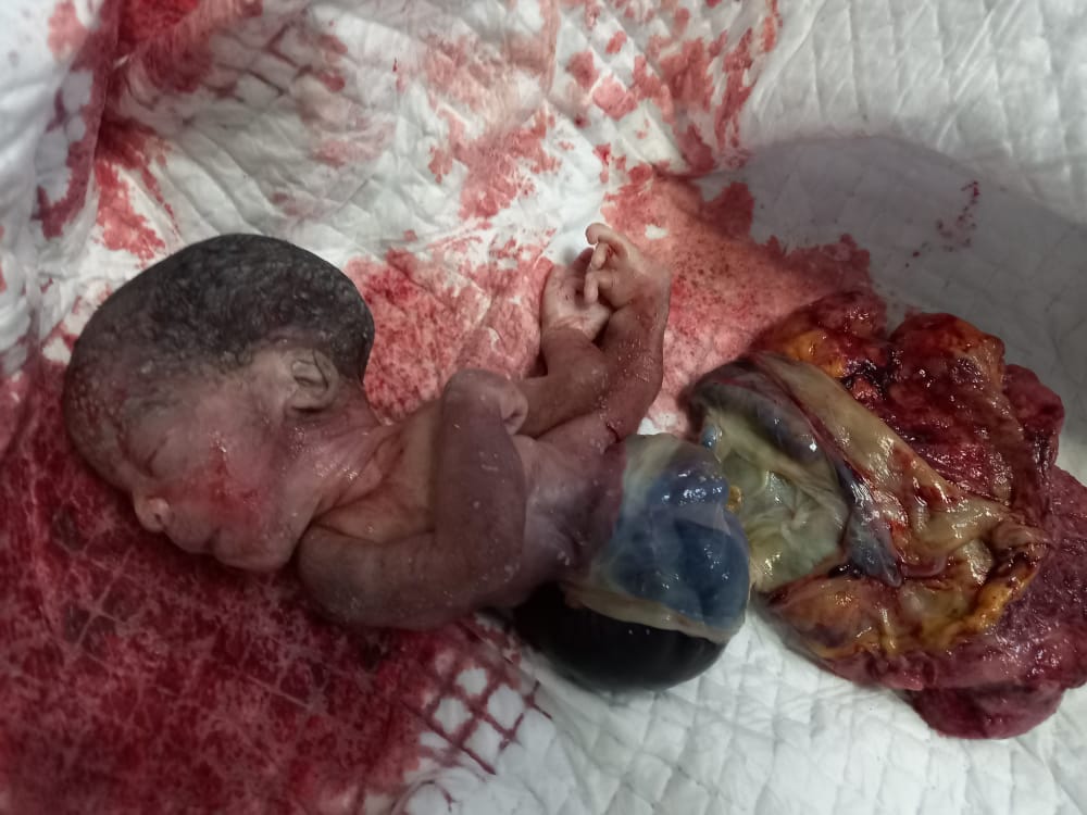 C:\Users\JUMBO\Downloads\Omphalocele 1.jpg