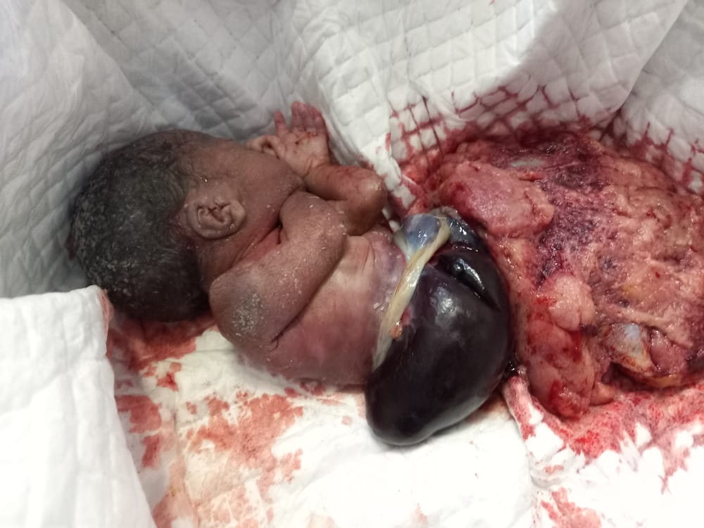 C:\Users\JUMBO\Downloads\Omphalocele 2.jpg